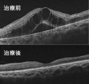 黃斑部治療術前術後照