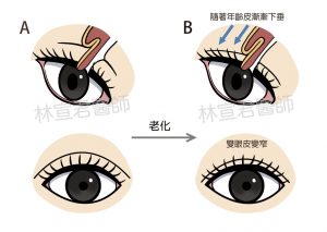 雙眼皮下垂示意圖