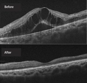 The before&after of the macular disease treatment 