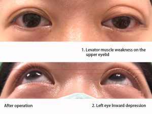 Before the treatment of double eyelids asymmetrical