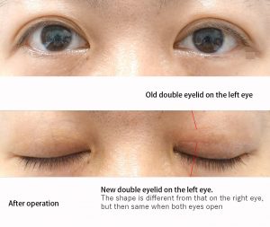 After the treatment of double eyelids asymmetrical