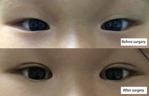The before&after of esotropia treatment