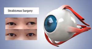 The before&after of strabismus treatment