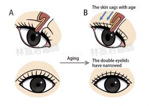 The image of droopy eyelids