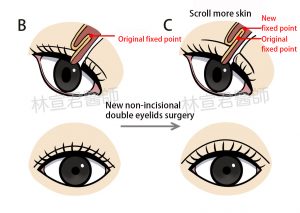 The image of non-incisional double eyelid surgery