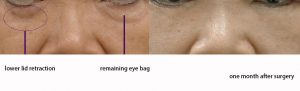 The before&after of the eye bag revision surgery