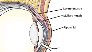 Ptosis correction structure