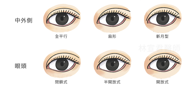 雙眼皮眼型種類