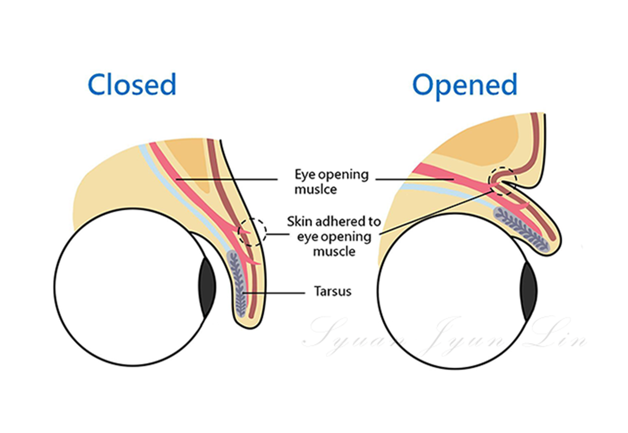 Double eyelid structure