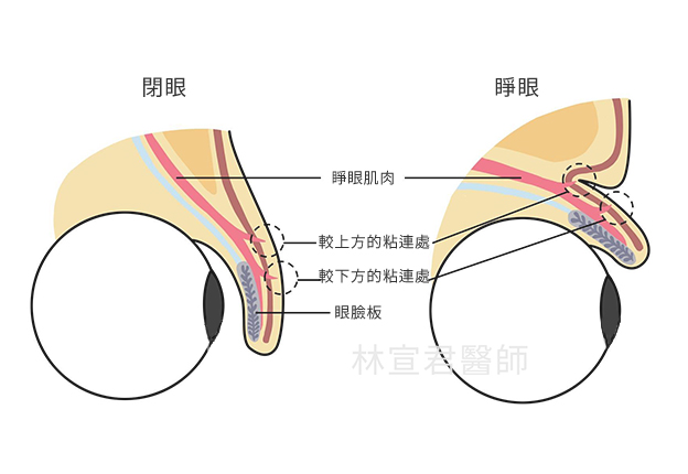 雙眼皮構造圖