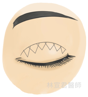 Non-incisional double eyelid surgery