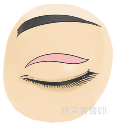 Incisional double eyelid surgery