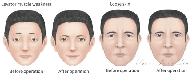 Before&After photo of leavtor muscle weakness and loose skin