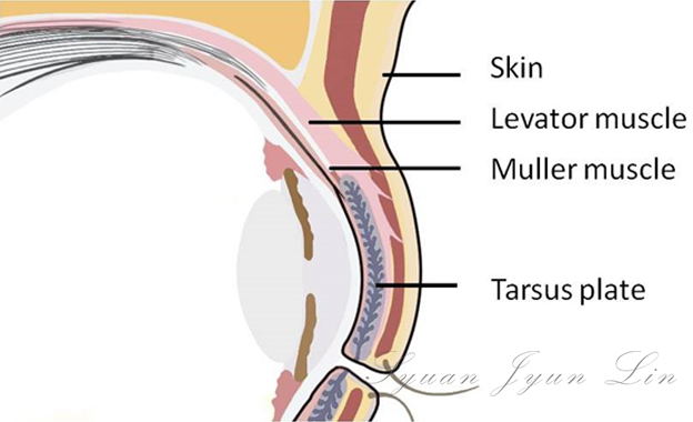 Ptosis correction structure