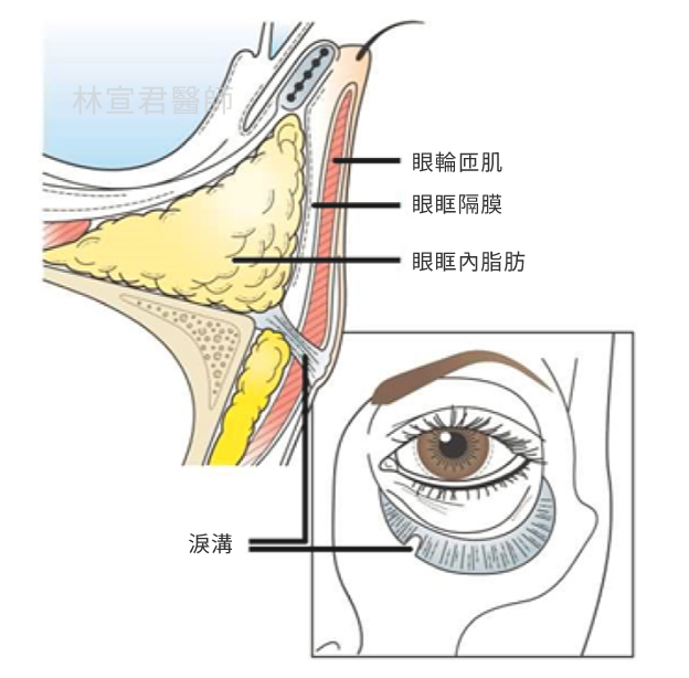 眼袋構造圖