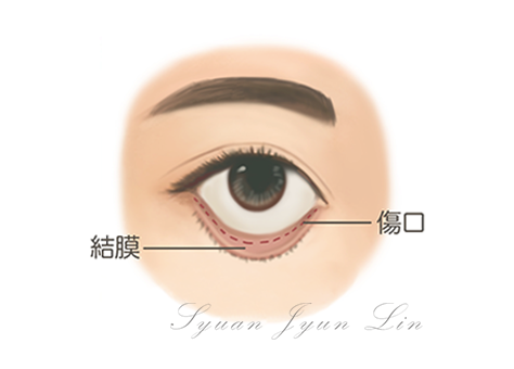 隱形眼袋手術圖