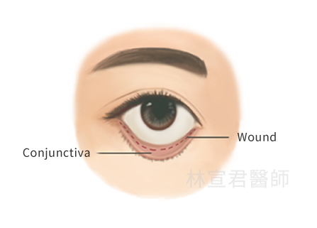 Transconjunctival eye bag surgery