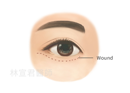 Transcutaneous eye bag surgery