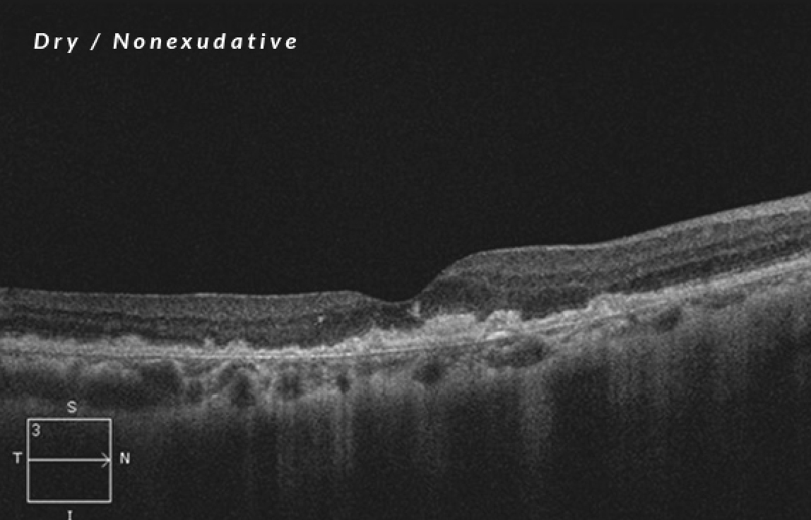 Dry/nonexudative age-related macular degeneration