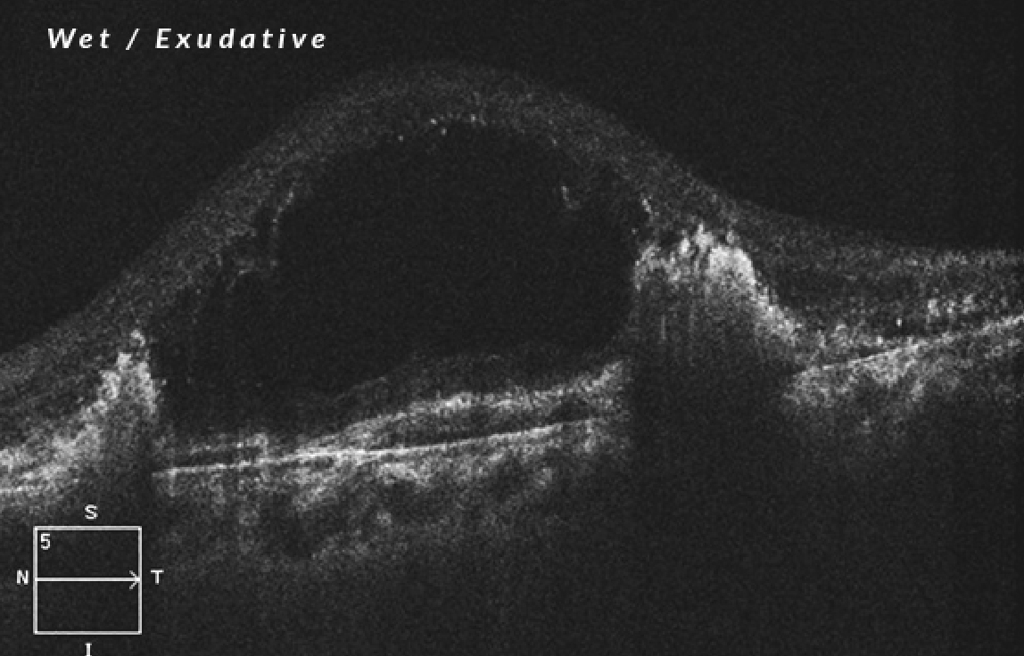 Wet/exudative age-related macular degeneration