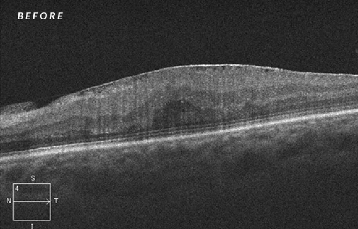 Before the treatment of epiretinal membrane removal surgery
