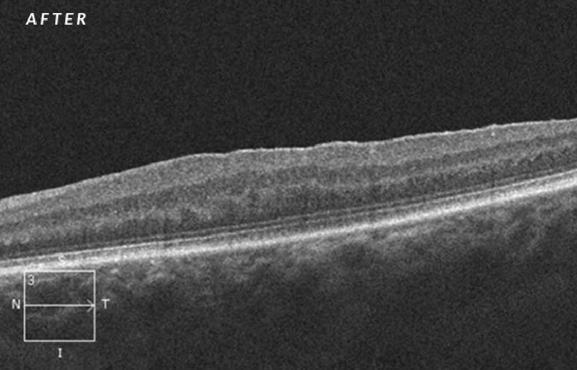 Before the treatment of the macular hole