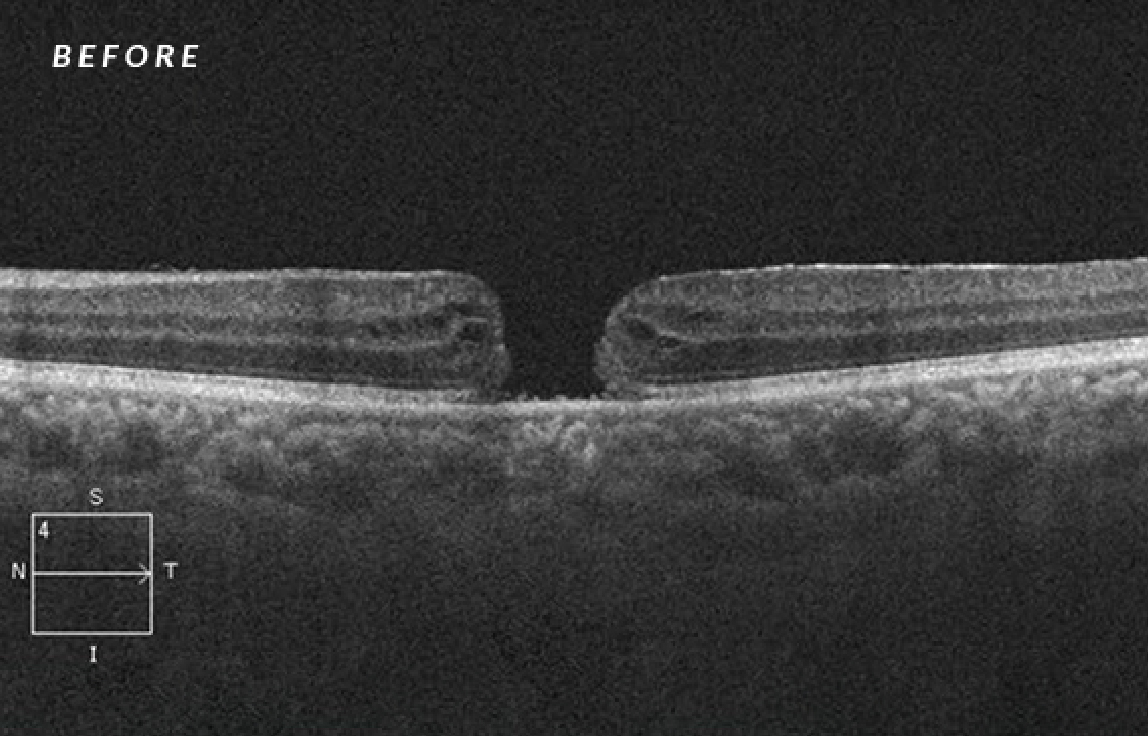Before the treatment of the macular hole