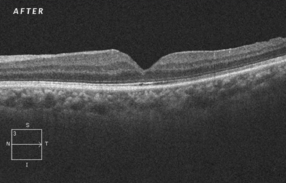 After the treatment of the macular hole
